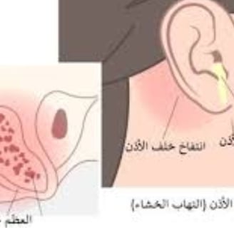 التهاب خلف الاذن افرازات من الاذن