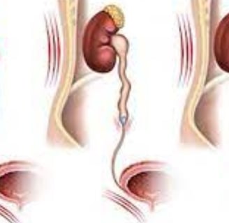 ureteric stone
