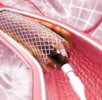 Cardiac Catheterization: Why Every Case Is Followed by a Stent