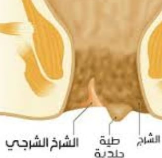 Analgesic properties: Honey relieves pain and itching associated with fissures and fistulas