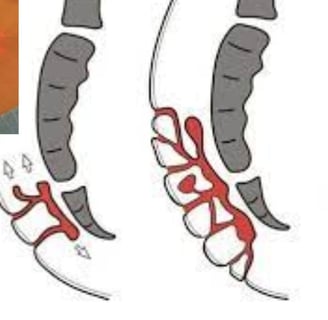 Home treatment of fistula My experience in treating fissures