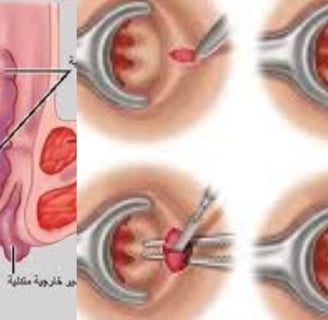 Anal fissures and fistulas: Treatment without surgery