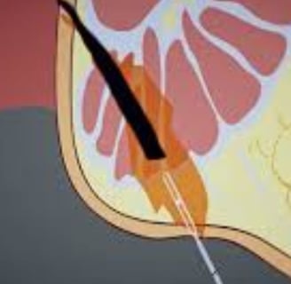 Anal fissures and fistulas: Treatment without surgery