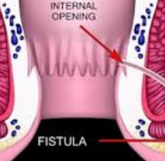 Water fasting or intermittent fasting may allow the digestive system to rest, reducing irritation in