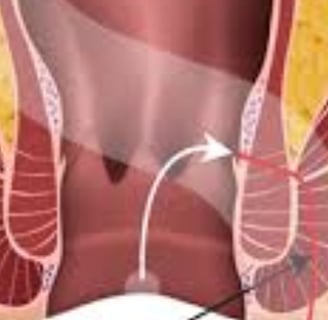Water fasting or intermittent fasting may allow the digestive system to rest, reducing irritation in