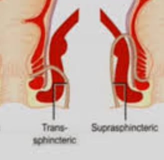 The use of honey in the management of anal fistulas may reduce pain and facilitate healing