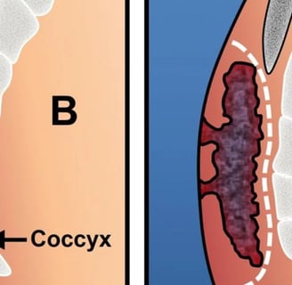 The use of honey in the management of anal fistulas may reduce pain and facilitate healing