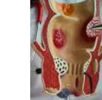 Analgesic properties: Honey relieves pain and itching associated with fissures and fistulas