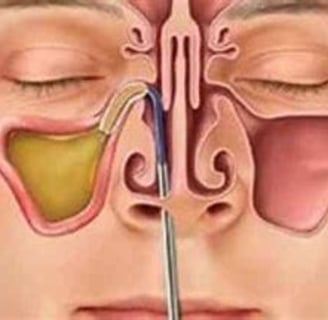 جيوب الانف العلاج علاج التهاب الجيوب الأنفية بالصيام والعسل