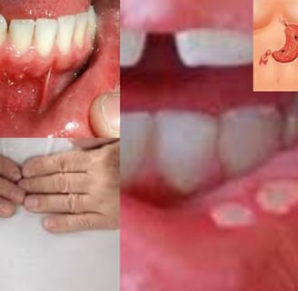 القرحة