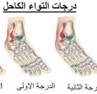 درجات التواء الكاحل