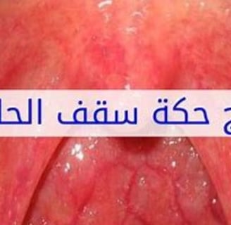 حكة بالحلق