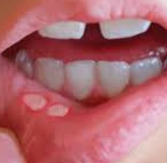 قرحة الفم المؤلمة