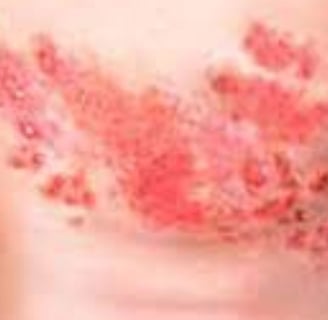 يتم تطبيق العسل مباشرة على المنطقة المصابة ويُترك لفترة تتراوح بين 20 إلى 30 دقيقة