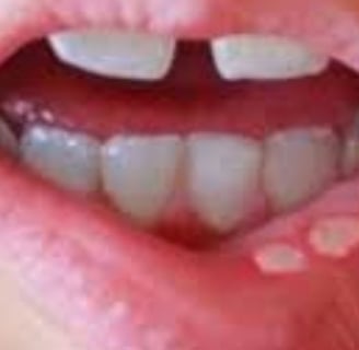 القرحة
