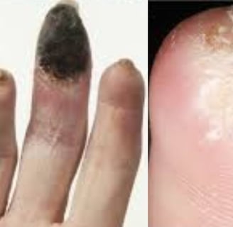 Painful Digital Ulcers : role of Role of Fasting and Cold Water