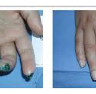 Painful Digital Ulcers : role of Role of Fasting and Cold Water