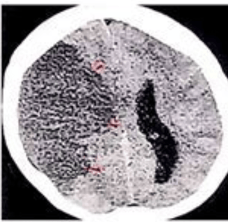 stroke ct