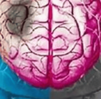 what is the best Post-stroke-stroke management