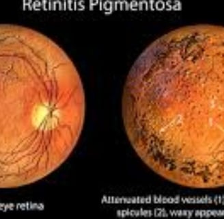 retinitis pigmentosa