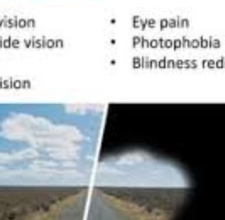symptoms of RP