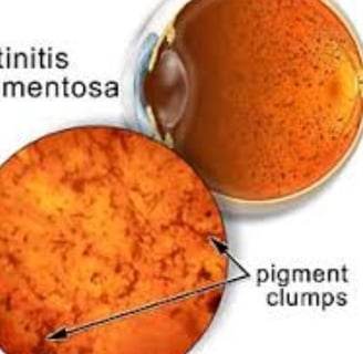 retinitis pigmentosa diagnosis