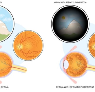 retinitis-pigmentosa
