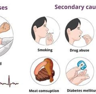 stroke causes