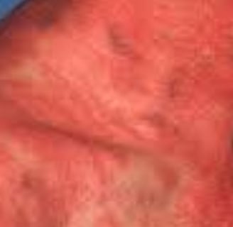 Herpes Zoster