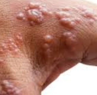 Shingles (Herpes Zoster) “Belt of Fire” Traditional vs. Strange Treatment
