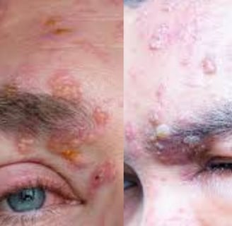 Shingles (Herpes Zoster) “Belt of Fire” Traditional vs. Strange Treatments