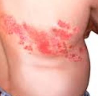 Shingles (Herpes Zoster) Ring of Fire : traditional vs strange treatment