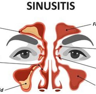 sinusitis