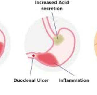 Stomach germ miracle healing of honey Monka honey and fasting (1)