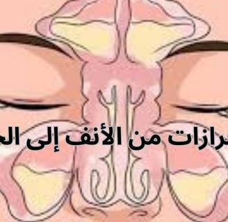 علاج إفرازات الأنف الخلفية الناجمة عن التهابات الجيوب