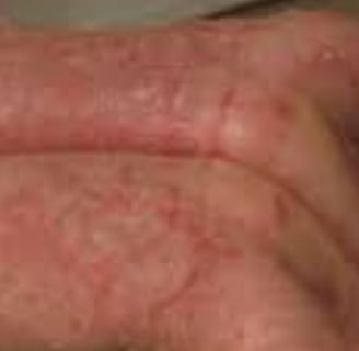 طفح جلدي أو ندوب حمراء، وقد تترافق مع حكة أو ألم
