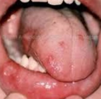 ماذا تعرف عن اسباب وتشخيص وعلاجات مرض بهجت