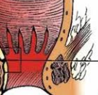 Using honey to treat fistulas is one of the effective methods that have been tried