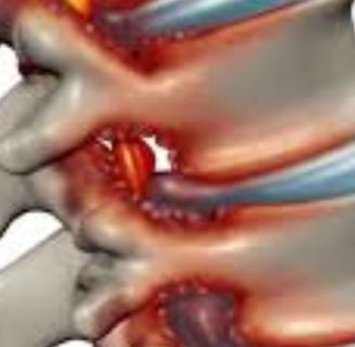 لعلاج الانزلاق الغضروفي