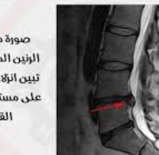 herniated disc,disc herniation,bulging disc,herniated disc surgery