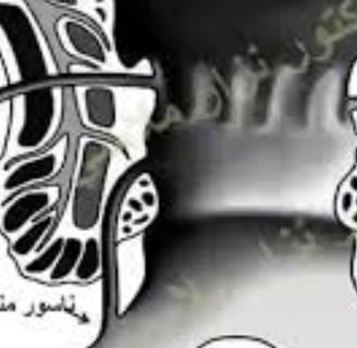 الشرخ و الناسور الشرجي