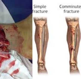 compound fracture