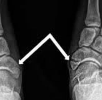 fracure foot
