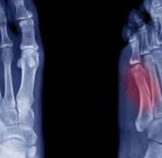 metatarsal fracure
