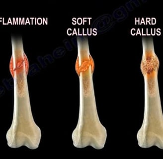 bone healing stages and precess