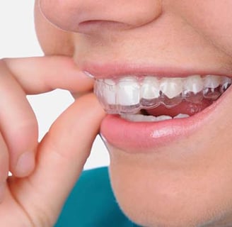 lưu ý khi niềng răng trong suốt