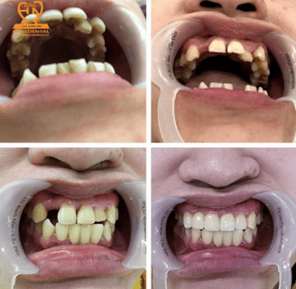 khách hàng niềng invisdental