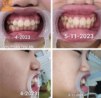 trước và sau niềng răng invisdental