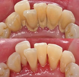 lấy cao răng định kỳ