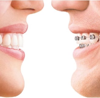 Niềng trong suốt và niềng mắc cài